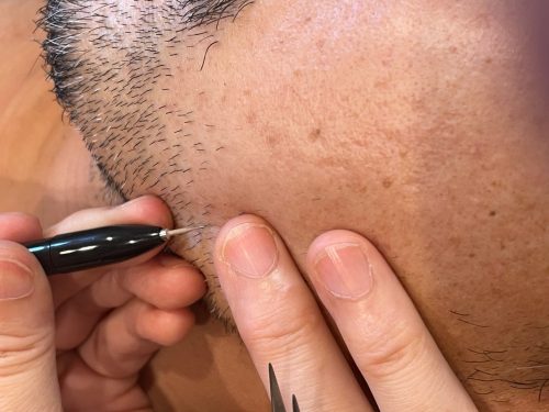 ニードル脱毛 髭のデザインや白髪 ほくろの上からも 近鉄八尾 完全個室 美容室 理容室 Trad Gently